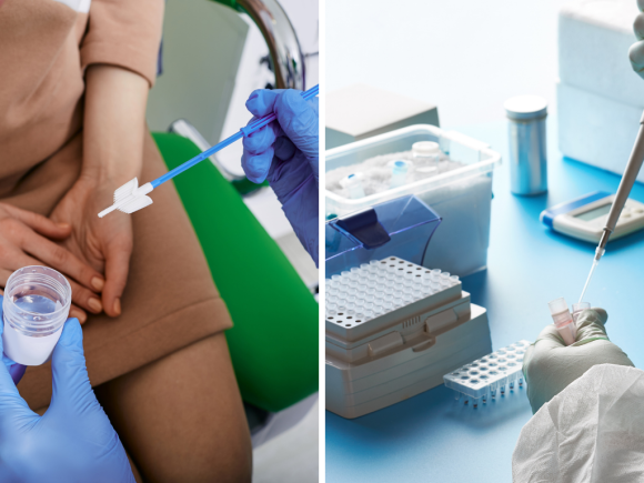 Deteksi Dini Kanker Serviks: Perbedaan PAP SMEAR dengan HPV DNA TEST